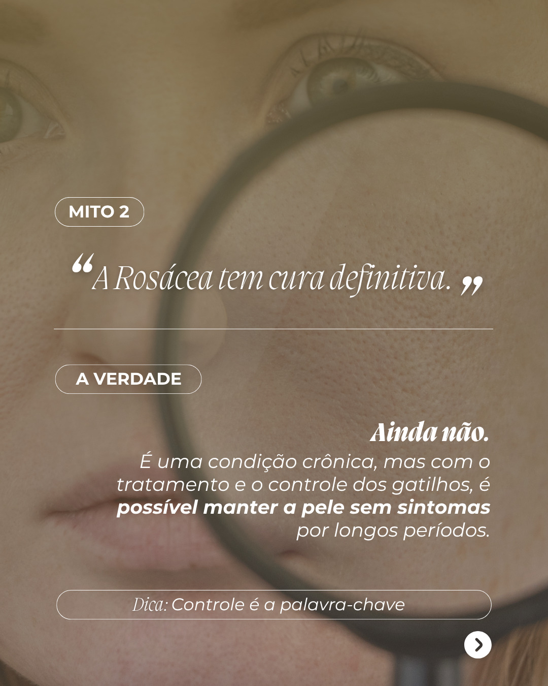 Rosacea3