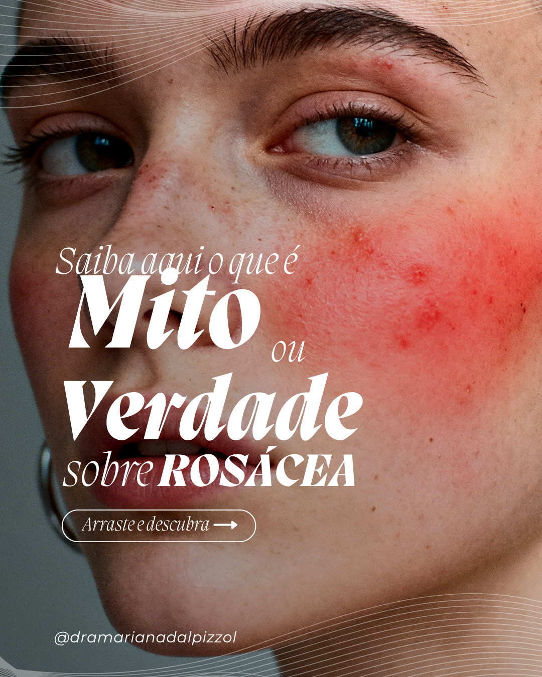 Rosaea1
